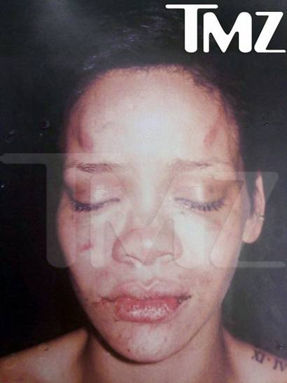 Rihanna After Chris Brown Beatdown.  Photo: TMZ.com Exclusive!