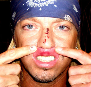 Bret Michaels Busted Nose & Lip.  Photo: Bret Michaels Via Facebook